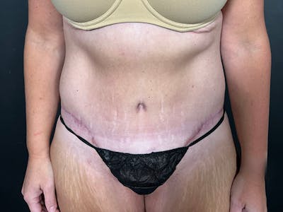Tummy Tuck Before & After Gallery - Patient 165824 - Image 2