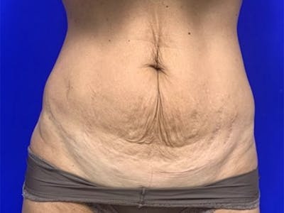 Mini Tummy Tuck Before & After Gallery - Patient 309547 - Image 1