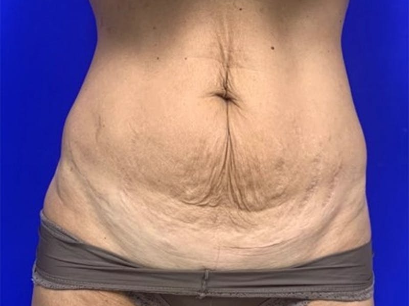 Mini Tummy Tuck Before & After Gallery - Patient 309547 - Image 1