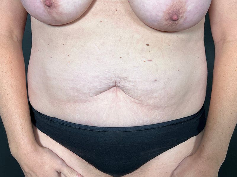 Abdomen Before & After Gallery - Patient 924975 - Image 1