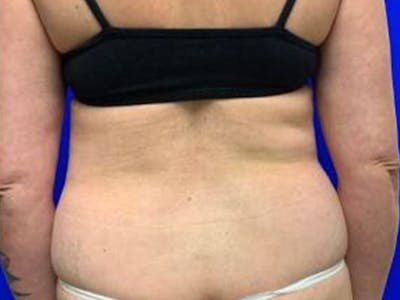 Back Before & After Gallery - Patient 407699 - Image 1