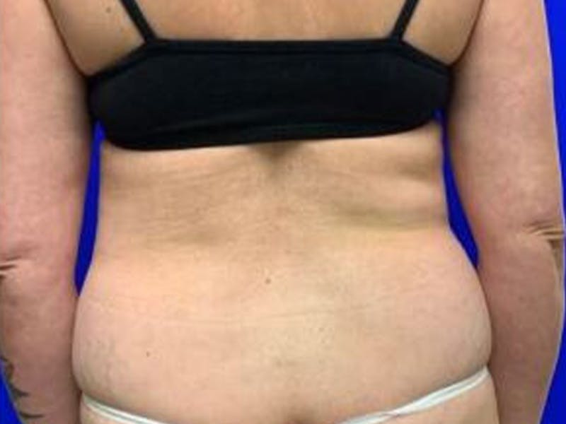 Back Before & After Gallery - Patient 407699 - Image 1
