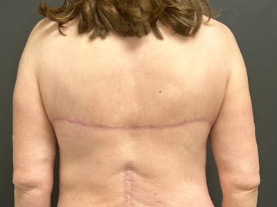 Back Lift Before & After Gallery - Patient 368284 - Image 2