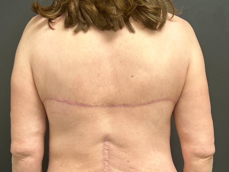 Back Lift Before & After Gallery - Patient 368284 - Image 2