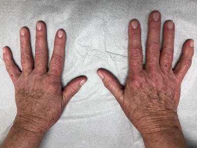 Hand Fat Grafting Before & After Gallery - Patient 195401 - Image 1