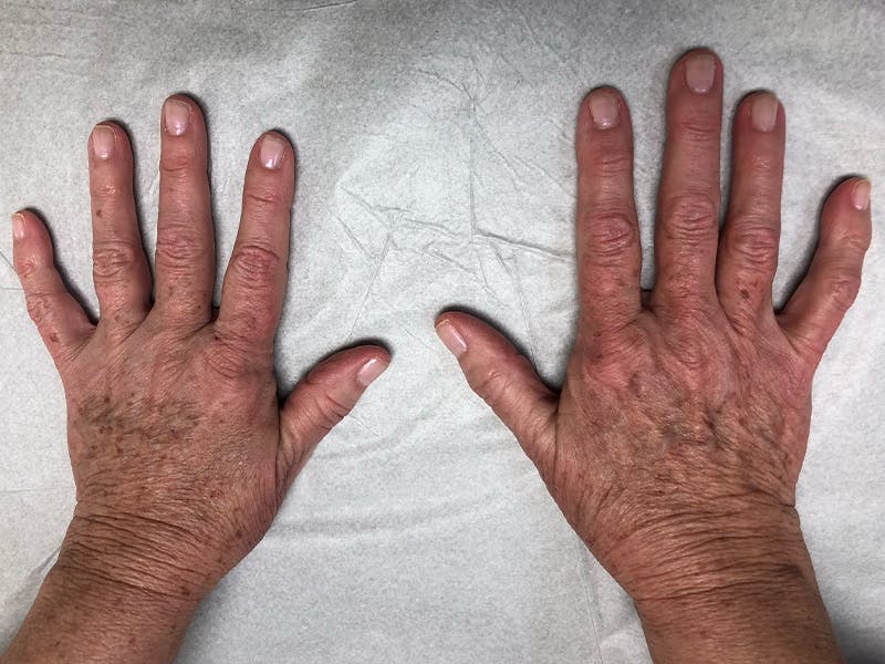 Hand Fat Grafting Before & After Gallery - Patient 195401 - Image 1