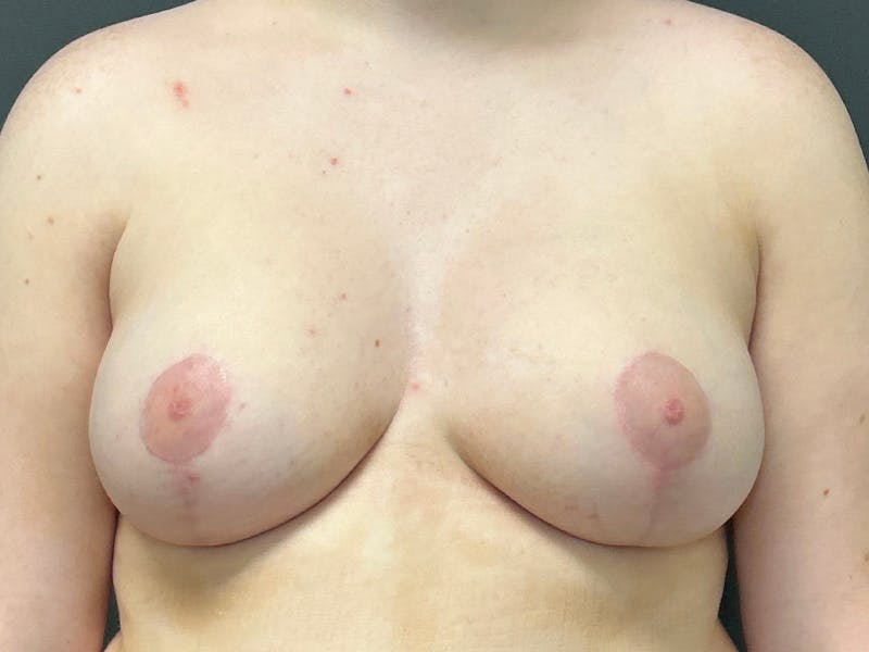 Breast Augmentation with Lift Before & After Gallery - Patient 132296 - Image 2