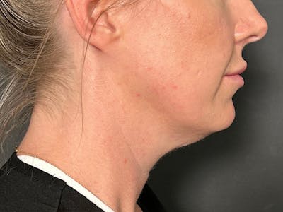 Submental Before & After Gallery - Patient 281129 - Image 1