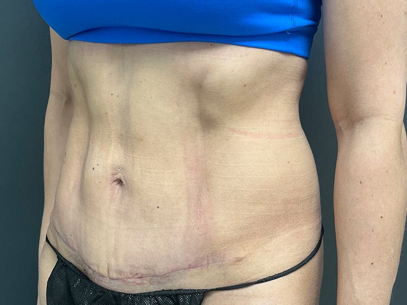 Mini Tummy Tuck Before & After Gallery - Patient 120272 - Image 8