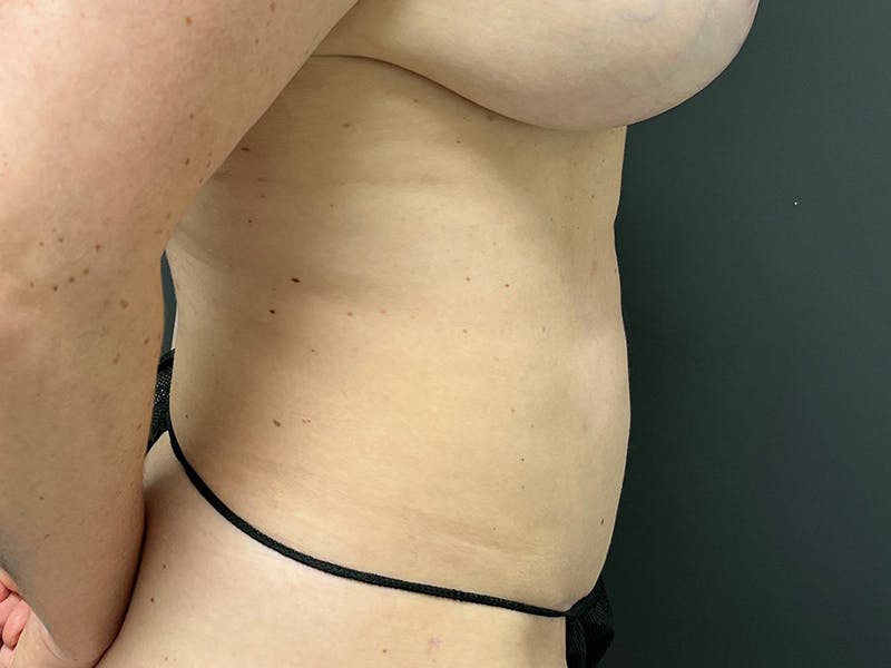 Mini Tummy Tuck Before & After Gallery - Patient 169656 - Image 6