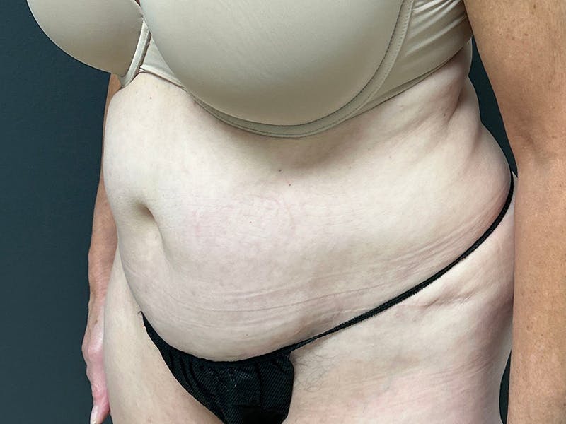 Abdomen Before & After Gallery - Patient 784997 - Image 7