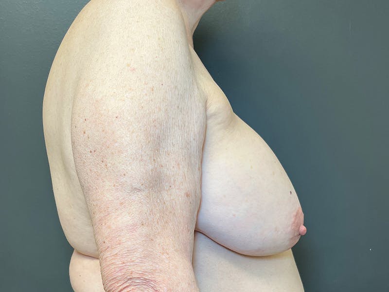 Breast Reconstruction Before & After Gallery - Patient 165209 - Image 5