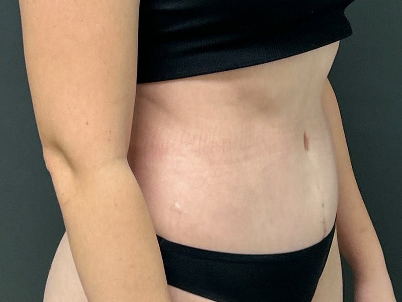 Tummy Tuck Before & After Gallery - Patient 266737 - Image 3