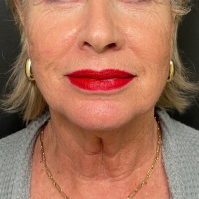 Facelift Before & After Gallery - Patient 211242 - Image 1
