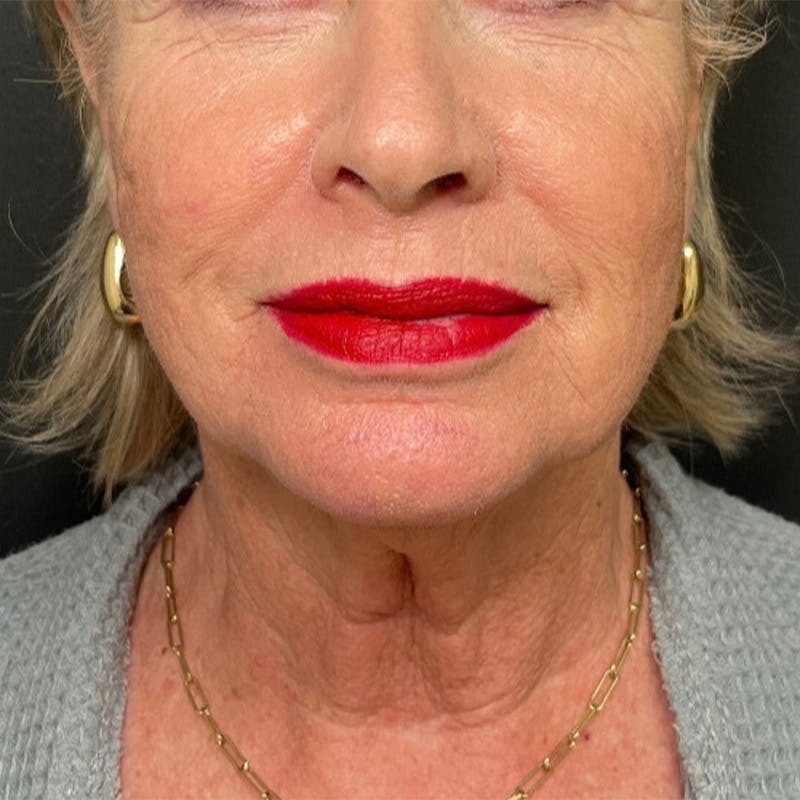 Facelift Before & After Gallery - Patient 211242 - Image 1