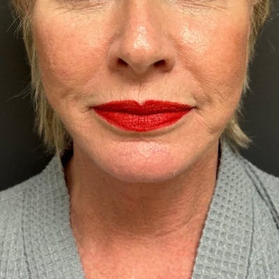Facelift Before & After Gallery - Patient 211242 - Image 2