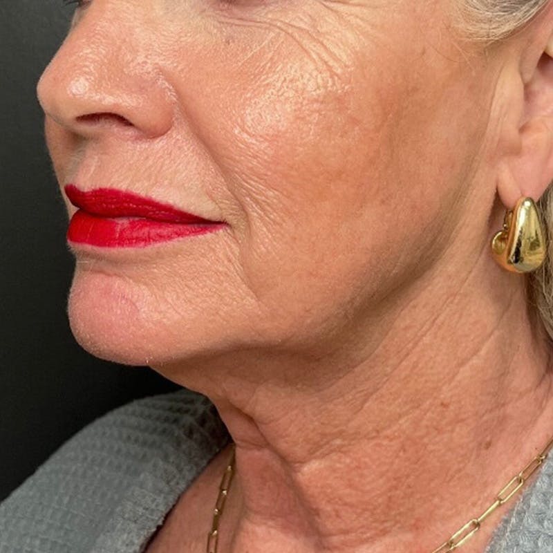 Facelift Before & After Gallery - Patient 211242 - Image 3