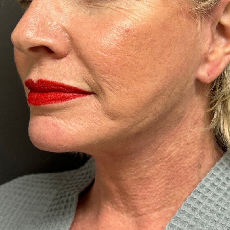 Facelift Before & After Gallery - Patient 211242 - Image 4