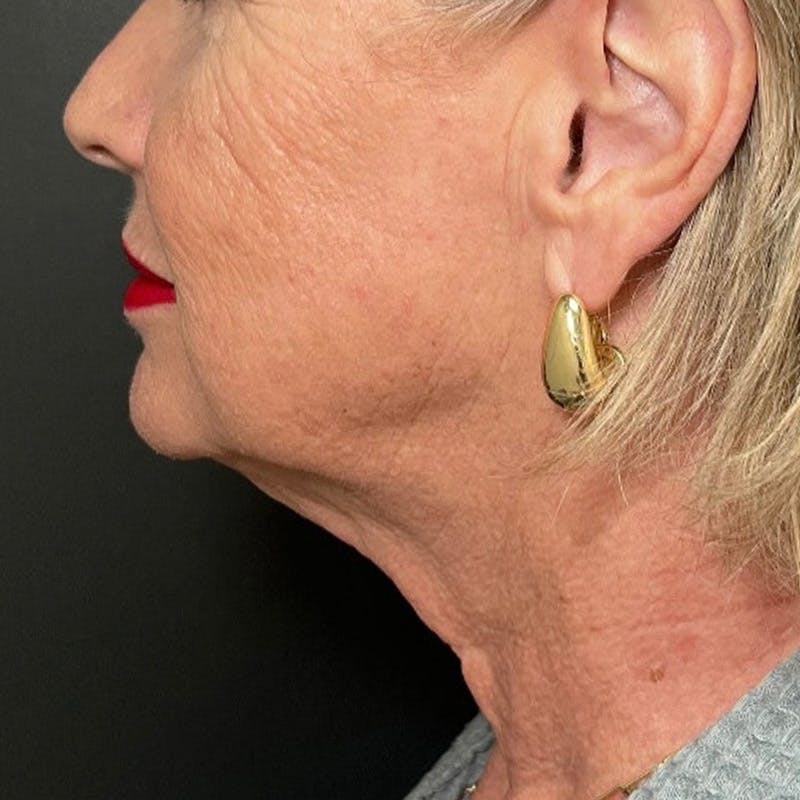 Facelift Before & After Gallery - Patient 211242 - Image 5