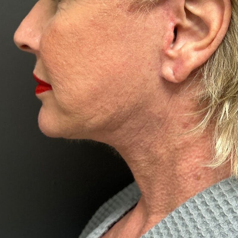 Facelift Before & After Gallery - Patient 211242 - Image 6