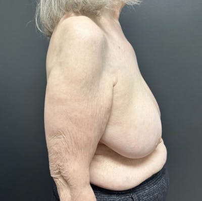 Breast Reduction Before & After Gallery - Patient 448607 - Image 1