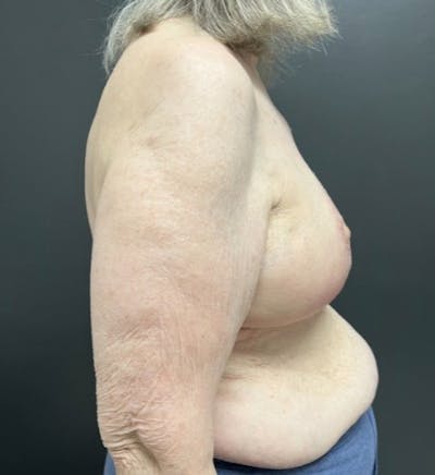 Breast Reduction Before & After Gallery - Patient 448607 - Image 2