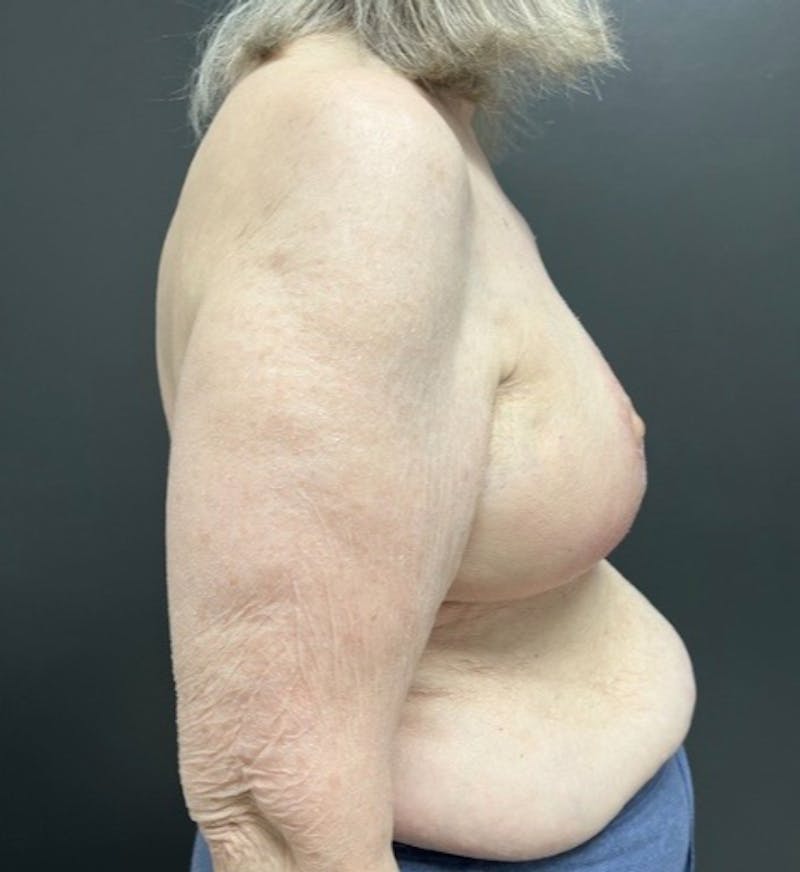 Breast Reduction Before & After Gallery - Patient 448607 - Image 2