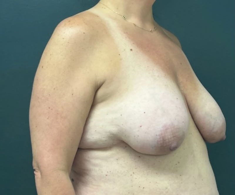 Breast Augmentation with Lift Before & After Gallery - Patient 314381 - Image 3