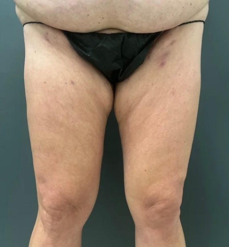 Liposuction Before & After Gallery - Patient 681715 - Image 1