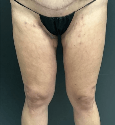 Liposuction Before & After Gallery - Patient 681715 - Image 2