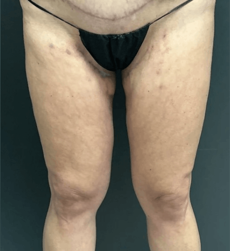 Liposuction Before & After Gallery - Patient 681715 - Image 2