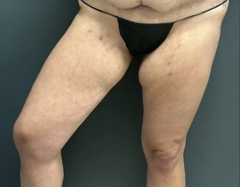 Liposuction Before & After Gallery - Patient 681715 - Image 3