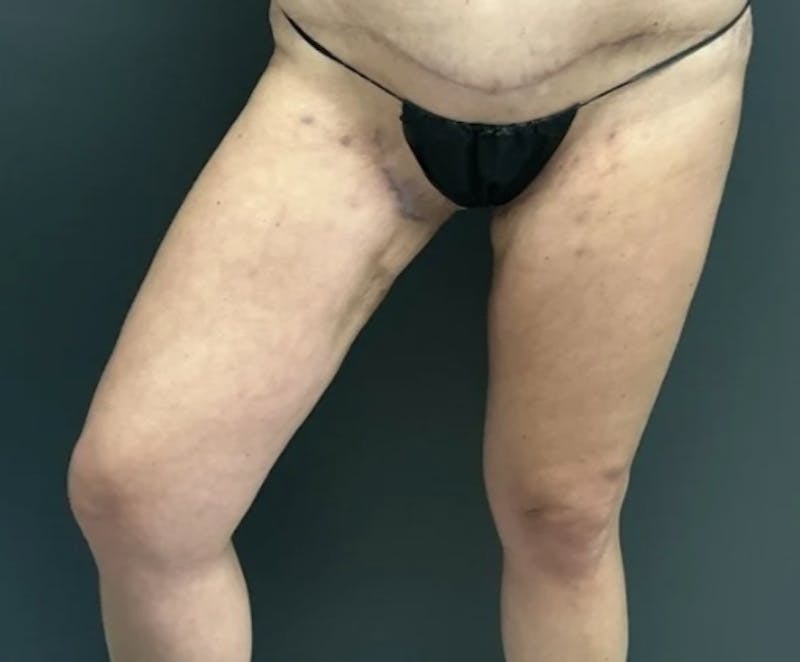 Liposuction Before & After Gallery - Patient 681715 - Image 4