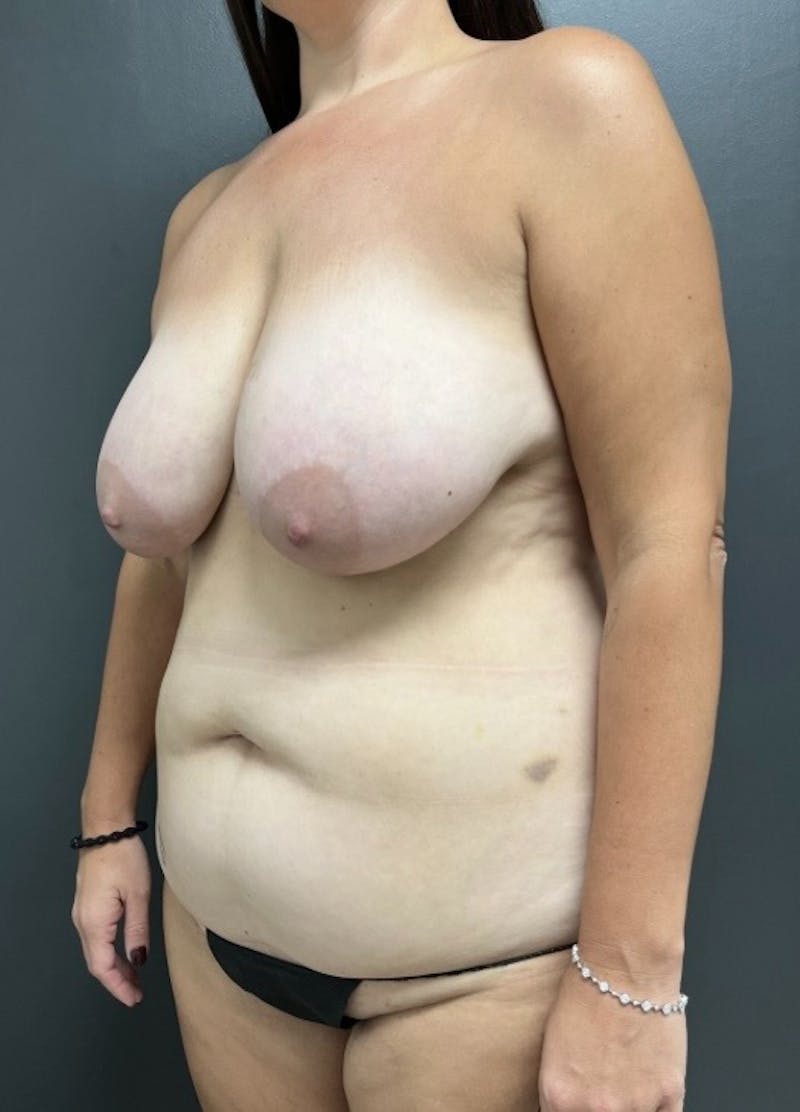 Abdominoplasty (Tummy Tuck) Before & After Gallery - Patient 276678 - Image 3