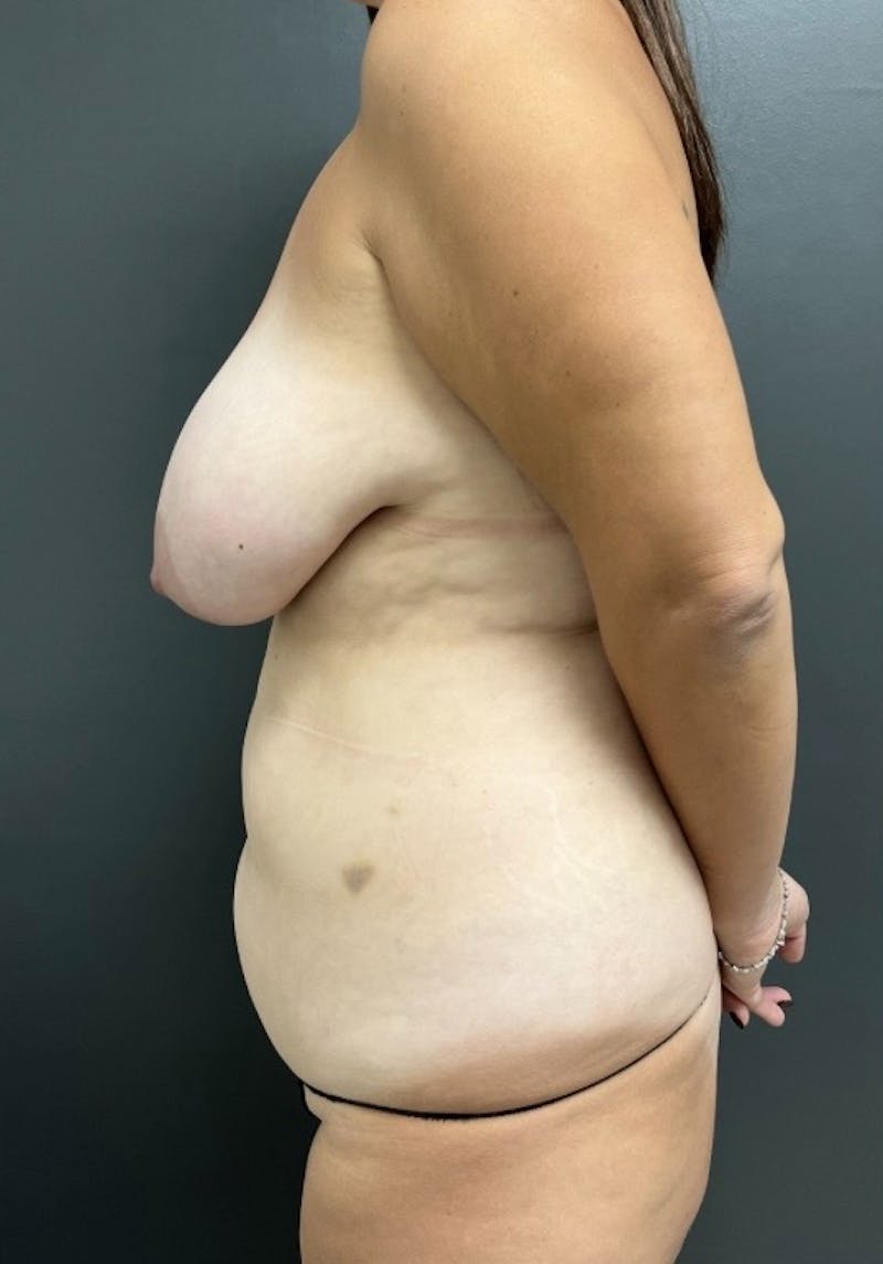 Abdominoplasty (Tummy Tuck) Before & After Gallery - Patient 276678 - Image 5