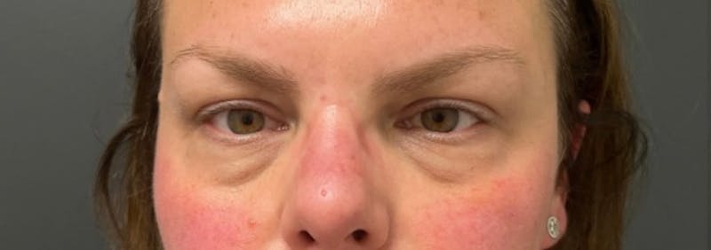 Blepharoplasty Before & After Gallery - Patient 114931 - Image 1
