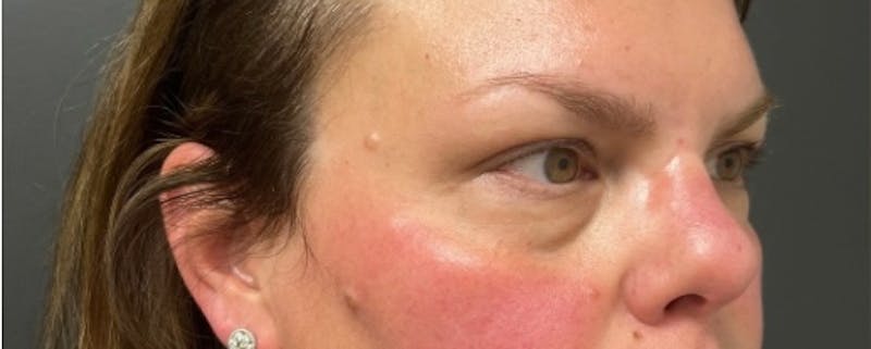 Blepharoplasty Before & After Gallery - Patient 114931 - Image 3