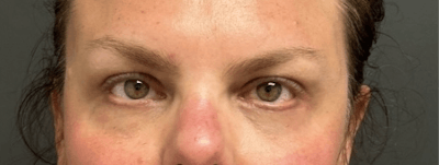 Blepharoplasty Before & After Gallery - Patient 114931 - Image 2