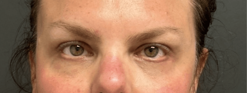 Blepharoplasty Before & After Gallery - Patient 114931 - Image 2