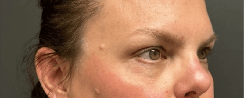 Blepharoplasty Before & After Gallery - Patient 114931 - Image 4