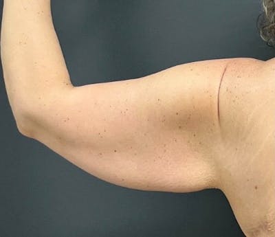 Arm Lift Before & After Gallery - Patient 173551 - Image 1