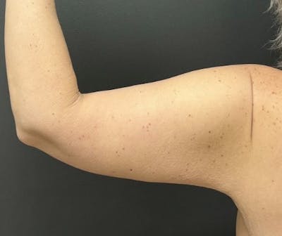 Arm Lift Before & After Gallery - Patient 173551 - Image 2