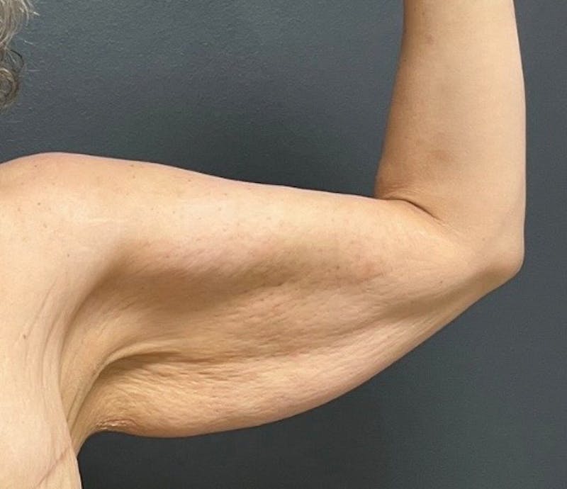 Brachioplasty (Arm Lift) Before & After Gallery - Patient 173551 - Image 3