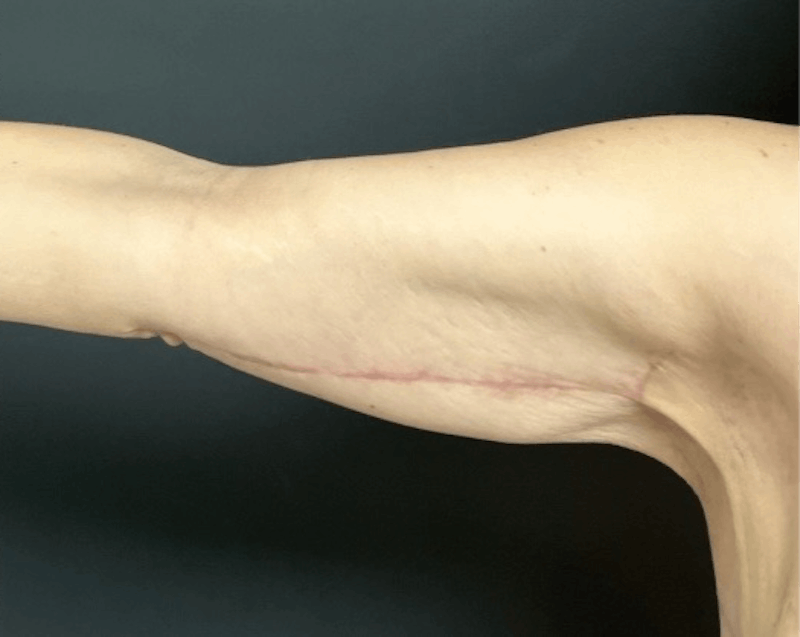 Brachioplasty (Arm Lift) Before & After Gallery - Patient 173551 - Image 6