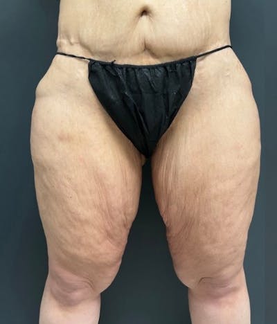 Thighplasty (Thigh Lift) Before & After Gallery - Patient 414383 - Image 1