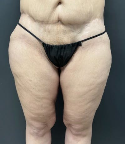Thighplasty (Thigh Lift) Before & After Gallery - Patient 414383 - Image 2