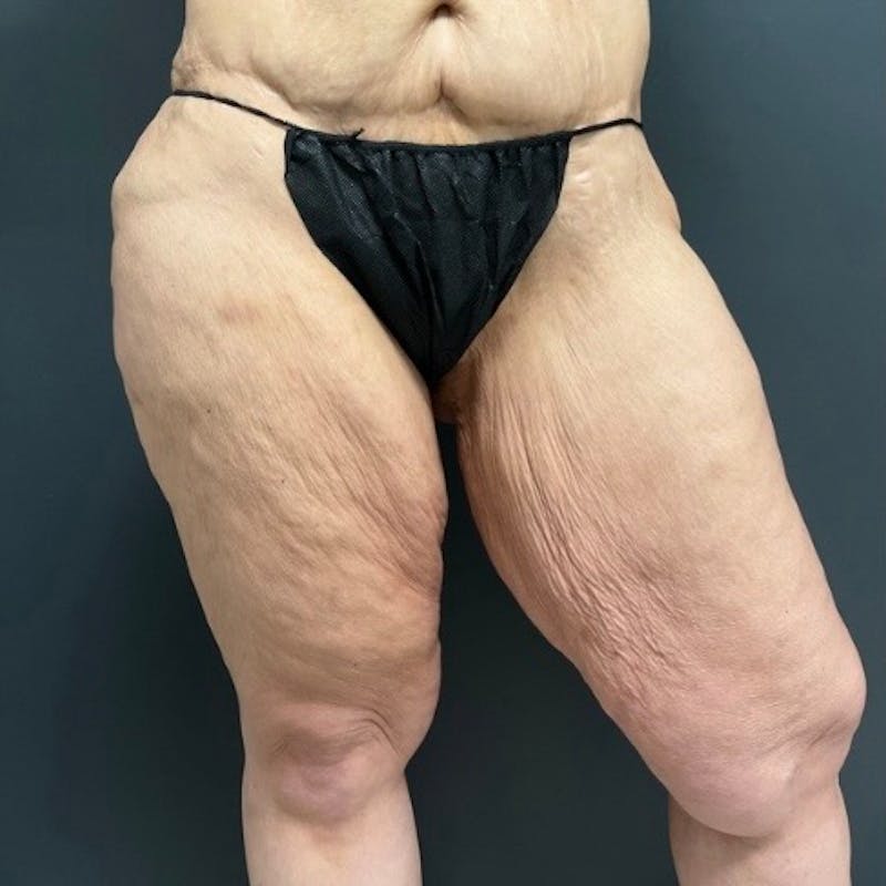 Thighplasty (Thigh Lift) Before & After Gallery - Patient 414383 - Image 3