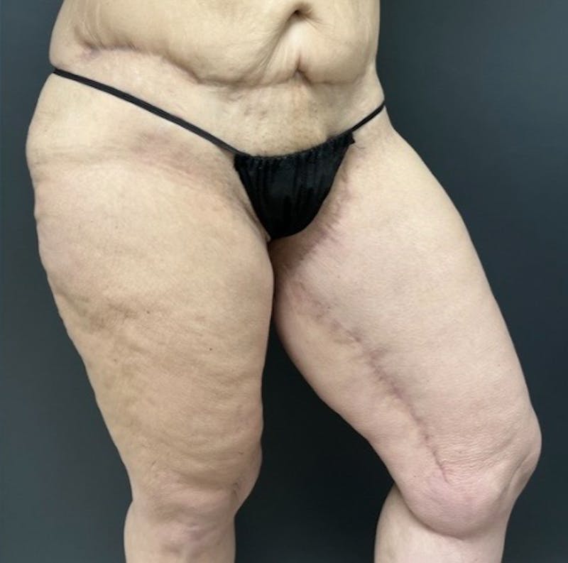 Thighplasty (Thigh Lift) Before & After Gallery - Patient 414383 - Image 4