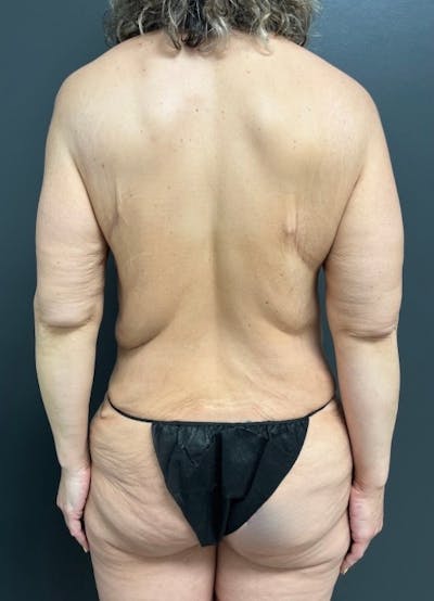 Back Lift Before & After Gallery - Patient 324257 - Image 1