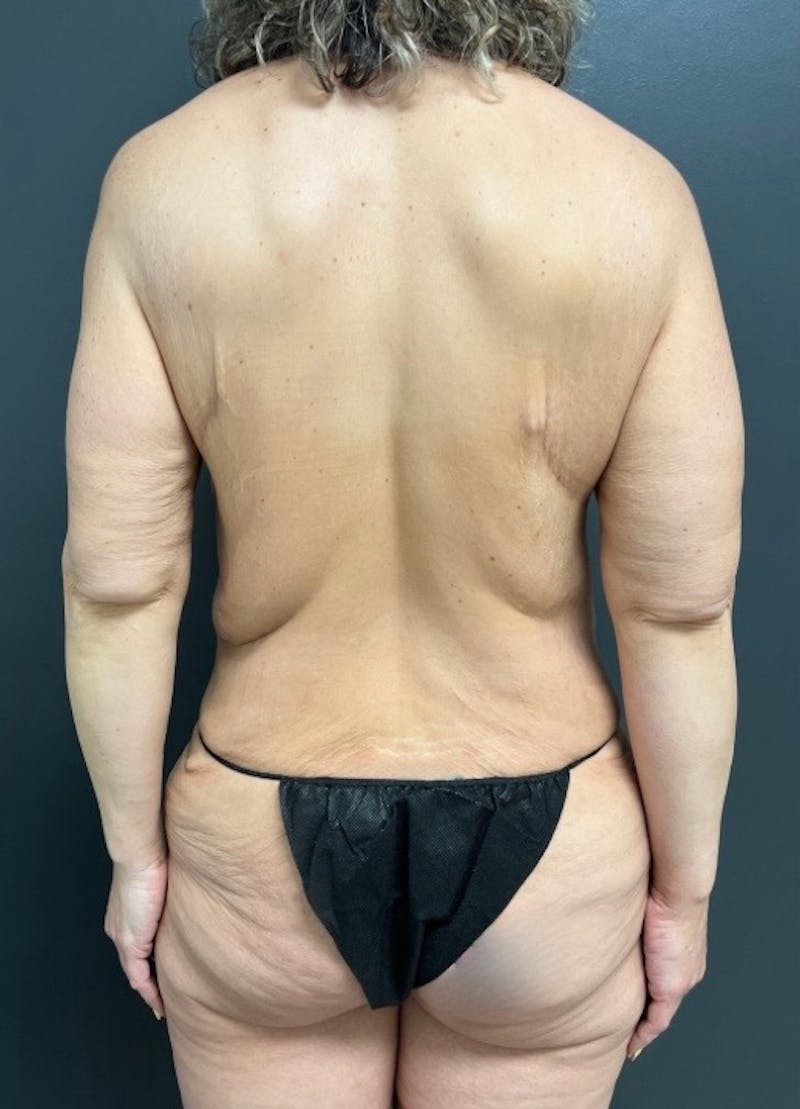 Back Lift Before & After Gallery - Patient 324257 - Image 1